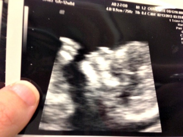 ultrasound at 18 weeks